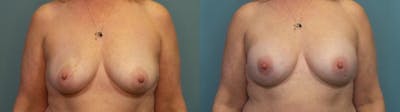Breast Reconstruction Before & After Gallery - Patient 128533 - Image 1