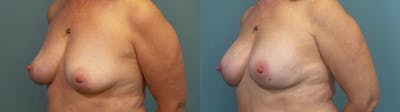 Breast Reconstruction Before & After Gallery - Patient 128533 - Image 2