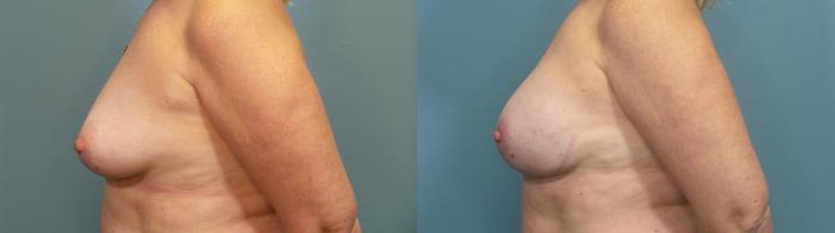 Breast Reconstruction Before & After Gallery - Patient 128533 - Image 3