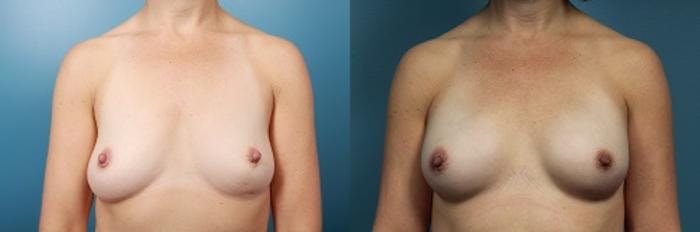 Breast Reconstruction Before & After Gallery - Patient 203589 - Image 1