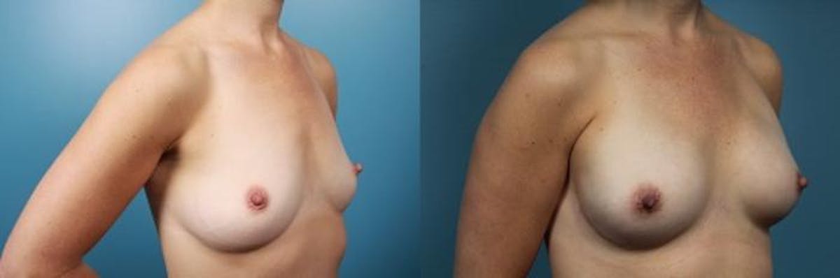 Breast Reconstruction Before & After Gallery - Patient 203589 - Image 2