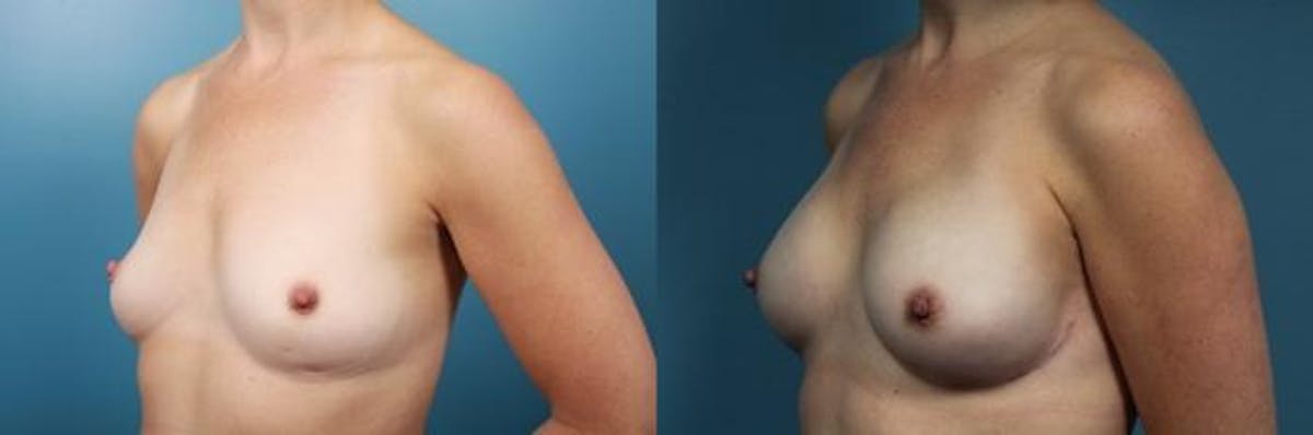 Breast Reconstruction Before & After Gallery - Patient 203589 - Image 3
