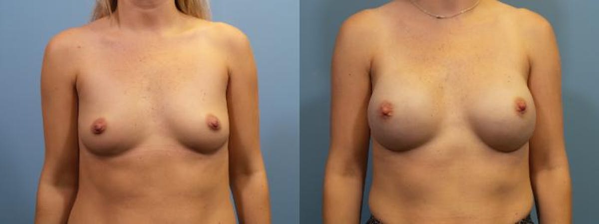 Breast Reconstruction Before & After Gallery - Patient 279383 - Image 1