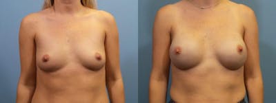 Breast Reconstruction Before & After Gallery - Patient 279383 - Image 1
