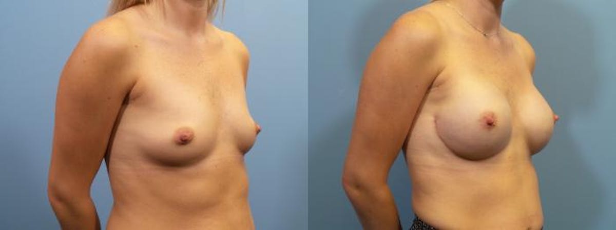Breast Reconstruction Before & After Gallery - Patient 279383 - Image 2