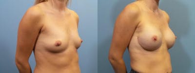 Breast Reconstruction Before & After Gallery - Patient 279383 - Image 2