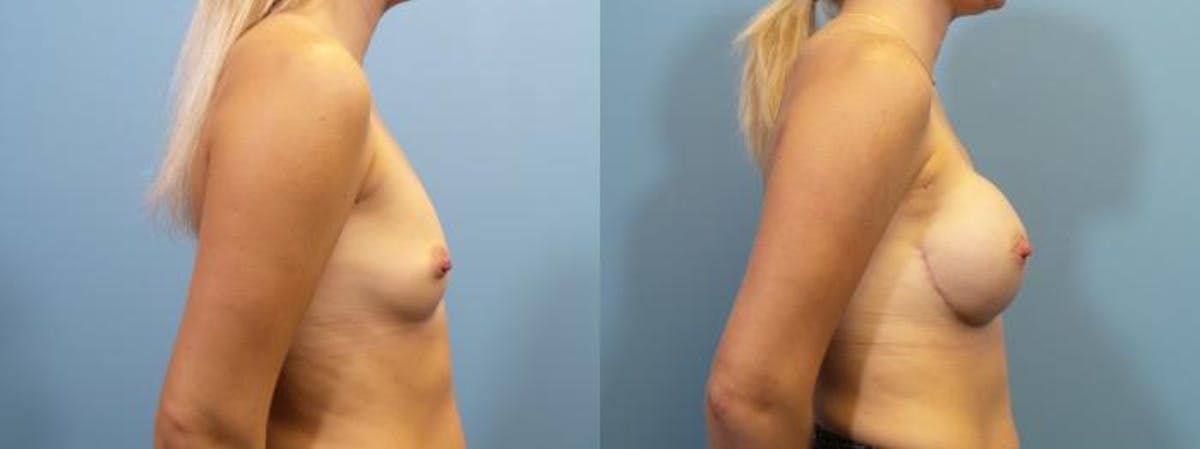 Breast Reconstruction Before & After Gallery - Patient 279383 - Image 3