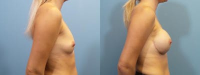 Breast Reconstruction Before & After Gallery - Patient 279383 - Image 3
