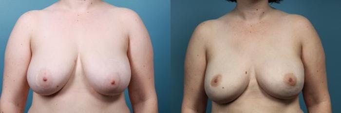 Breast Reconstruction Before & After Gallery - Patient 208109 - Image 1
