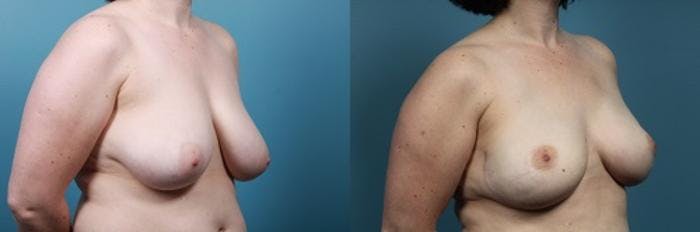 Breast Reconstruction Before & After Gallery - Patient 208109 - Image 2