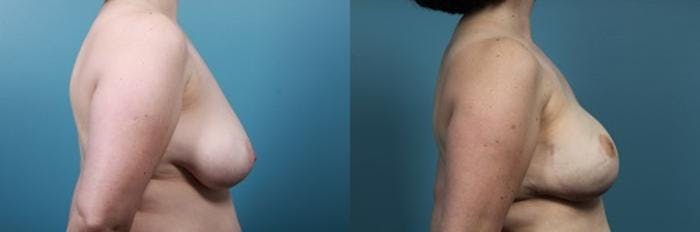 Breast Reconstruction Before & After Gallery - Patient 208109 - Image 3