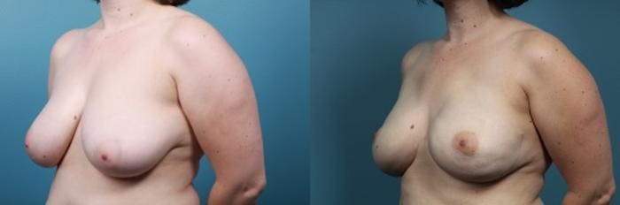 Breast Reconstruction Before & After Gallery - Patient 208109 - Image 4
