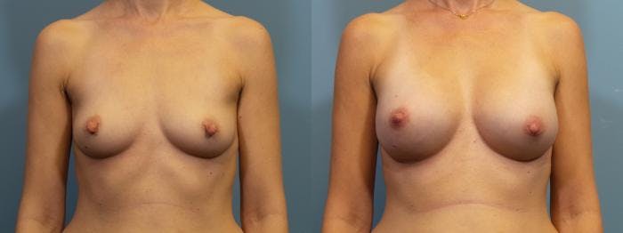 Breast Reconstruction Before & After Gallery - Patient 404890 - Image 1