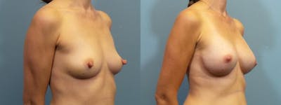 Breast Reconstruction Before & After Gallery - Patient 404890 - Image 2