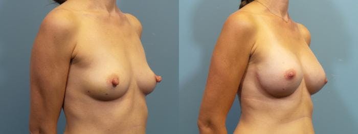 Breast Reconstruction Before & After Gallery - Patient 404890 - Image 2