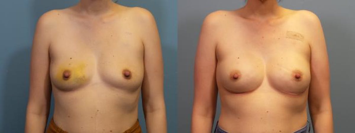 Breast Reconstruction Before & After Gallery - Patient 224846 - Image 1
