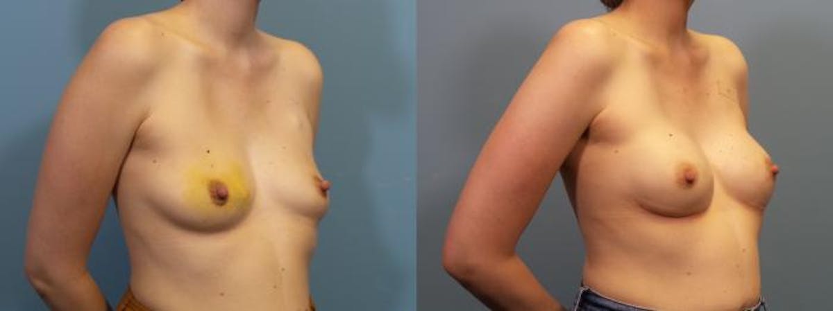 Breast Reconstruction Before & After Gallery - Patient 224846 - Image 2