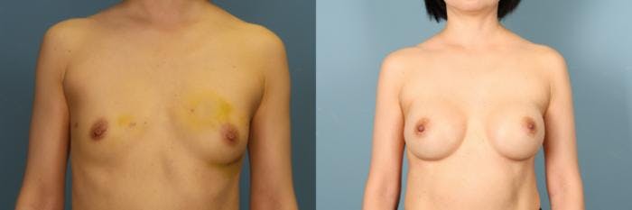 Breast Reconstruction Before & After Gallery - Patient 248533 - Image 1