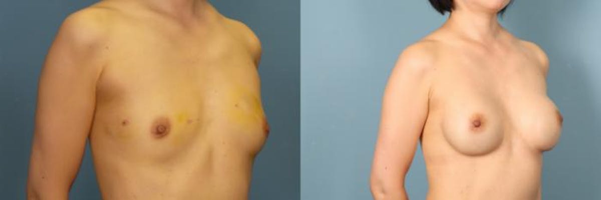 Breast Reconstruction Before & After Gallery - Patient 248533 - Image 2