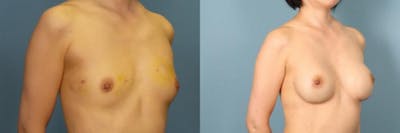 Breast Reconstruction Before & After Gallery - Patient 248533 - Image 2