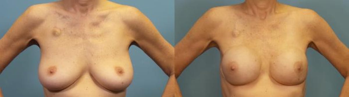 Breast Reconstruction Before & After Gallery - Patient 424533 - Image 1