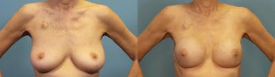 Breast Reconstruction Before & After Gallery - Patient 424533 - Image 1