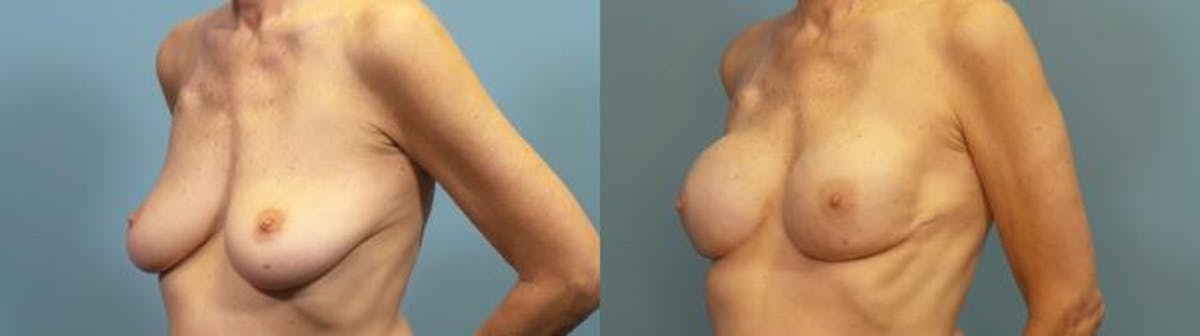 Breast Reconstruction Before & After Gallery - Patient 424533 - Image 2