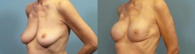 Breast Reconstruction Before & After Gallery - Patient 424533 - Image 2