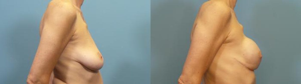 Breast Reconstruction Before & After Gallery - Patient 424533 - Image 3