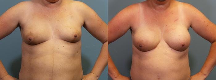 Breast Reconstruction Before & After Gallery - Patient 757187 - Image 1