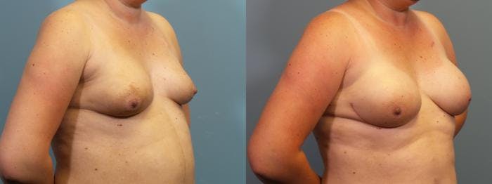 Breast Reconstruction Before & After Gallery - Patient 757187 - Image 2