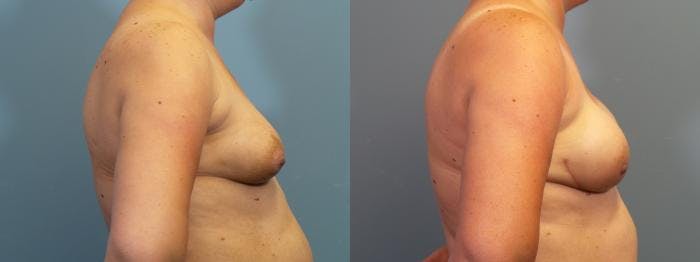 Breast Reconstruction Before & After Gallery - Patient 757187 - Image 3