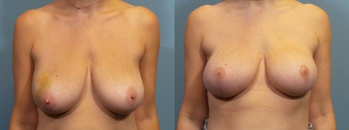 Breast Reconstruction Before & After Gallery - Patient 302987 - Image 1