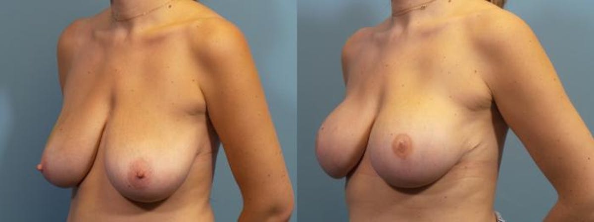 Breast Reconstruction Before & After Gallery - Patient 302987 - Image 2