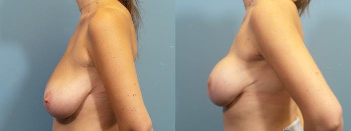 Breast Reconstruction Before & After Gallery - Patient 302987 - Image 3