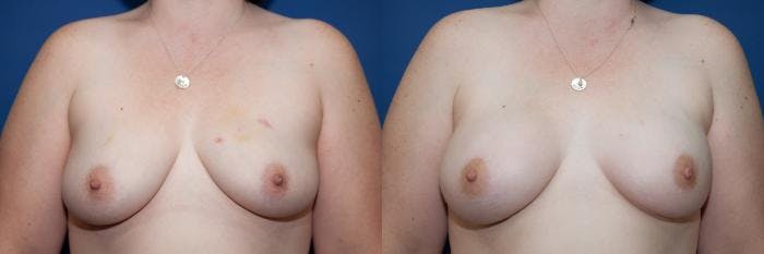 Breast Reconstruction Before & After Gallery - Patient 111875 - Image 1