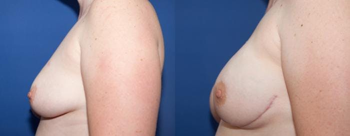Breast Reconstruction Before & After Gallery - Patient 111875 - Image 2