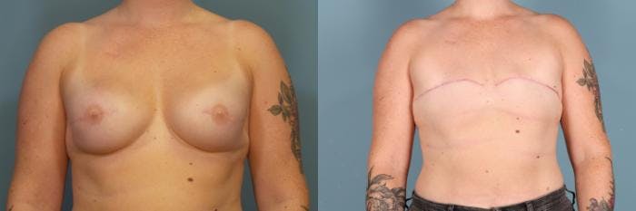 Breast Reconstruction Before & After Gallery - Patient 208177 - Image 1