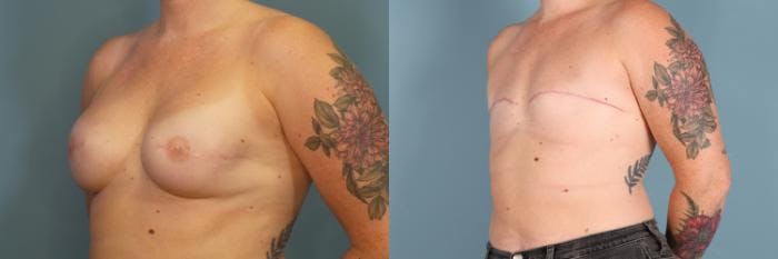 Breast Reconstruction Before & After Gallery - Patient 208177 - Image 2