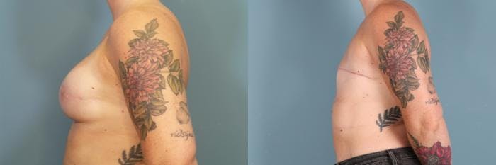 Breast Reconstruction Before & After Gallery - Patient 208177 - Image 3