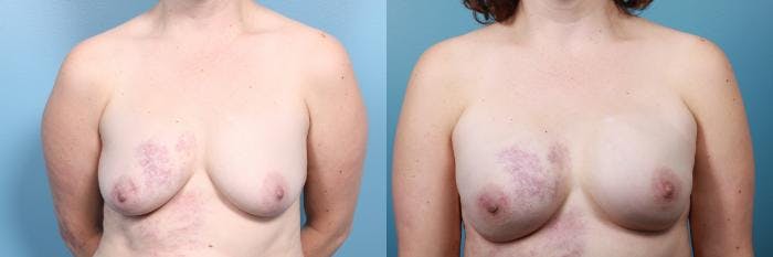 Breast Reconstruction Before & After Gallery - Patient 156735 - Image 1