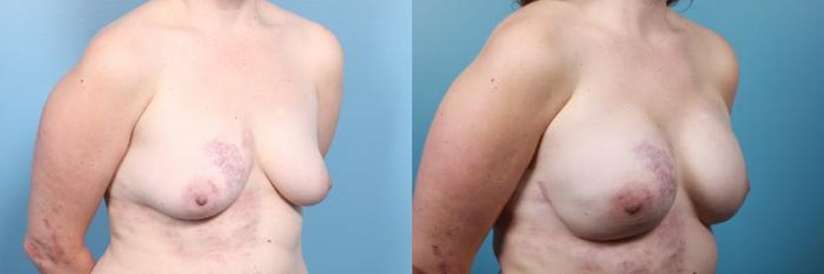 Breast Reconstruction Before & After Gallery - Patient 156735 - Image 2