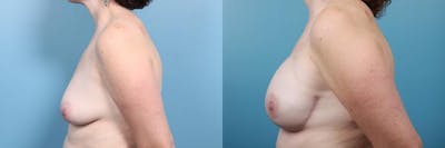 Breast Reconstruction Before & After Gallery - Patient 156735 - Image 3
