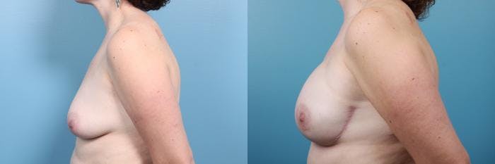 Breast Reconstruction Before & After Gallery - Patient 156735 - Image 3