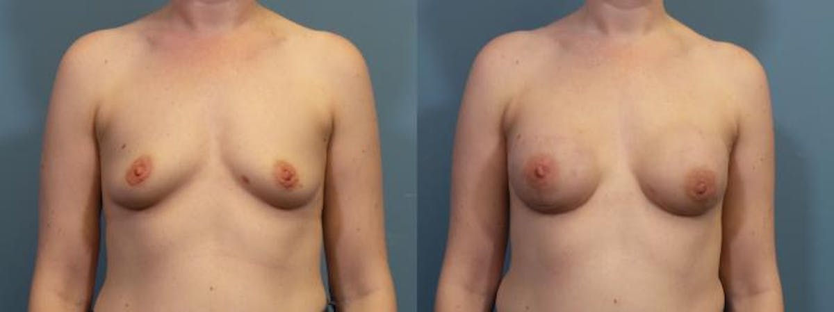 Breast Reconstruction Before & After Gallery - Patient 294989 - Image 1