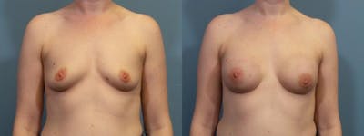Breast Reconstruction Before & After Gallery - Patient 294989 - Image 1