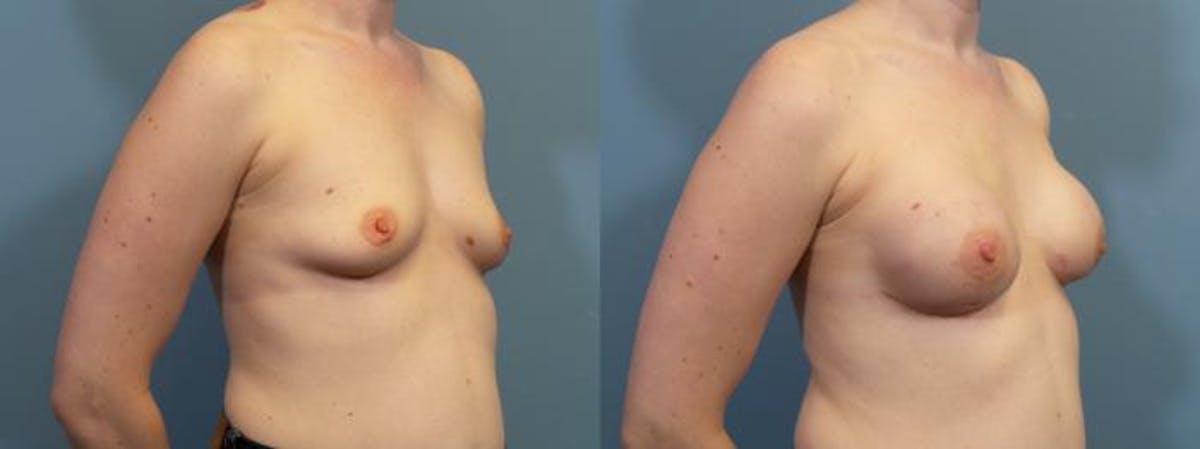 Breast Reconstruction Before & After Gallery - Patient 294989 - Image 2