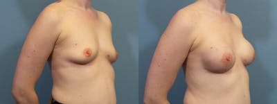Breast Reconstruction Before & After Gallery - Patient 294989 - Image 2