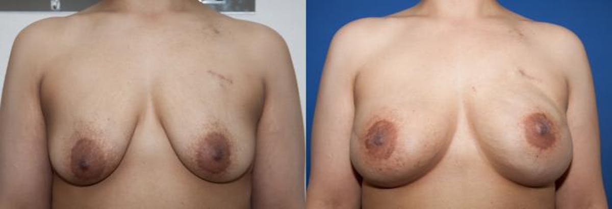 Breast Reconstruction Before & After Gallery - Patient 384077 - Image 1