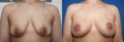 Breast Reconstruction Before & After Gallery - Patient 384077 - Image 1